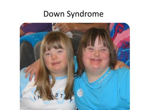 Ppt Down Syndrome Trisomy 21 Powerpoint Presentation Id2170957