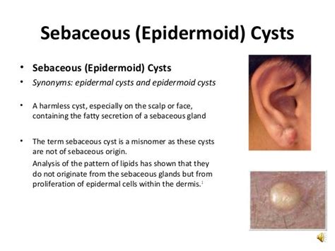 Epidermoid Cyst Vs Sebaceous Cyst What To Expect From A Cyst Removal The Best Cyst Removal