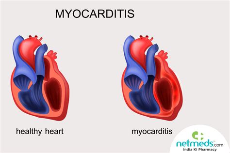 Myocarditis Causes Symptoms And Treatment
