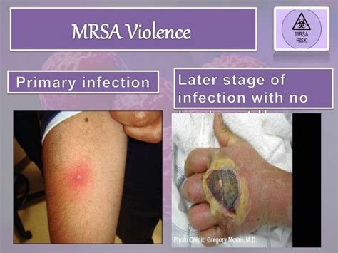 Removing Pictorial Mussels To Prevent Mrsa Infections Anchorandhopesf