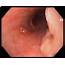 ENDOSCOPIC IMAGE OF A MASS IN THE ESOPHAGUS WITH CENTRAL DEPRESSION 