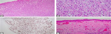 Acantholytic Squamous Cell Carcinoma Arising From Lichen Scl