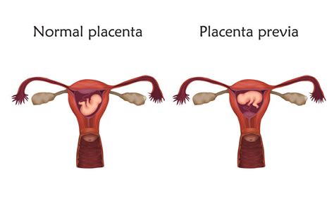 Are You At Risk For Placenta Previa Texas Health Care Obstetrics