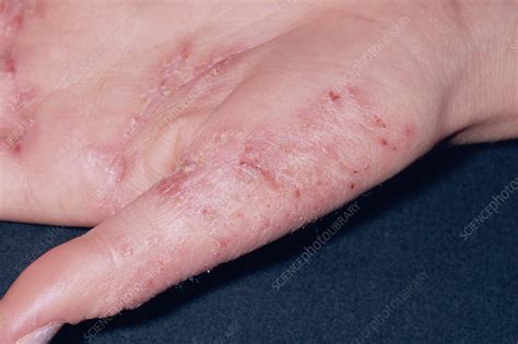 Eczema Stock Image M1500193 Science Photo Library