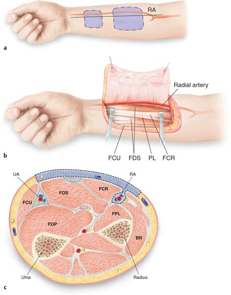 Pedicled Radial Forearm Flap Musculoskeletal Key