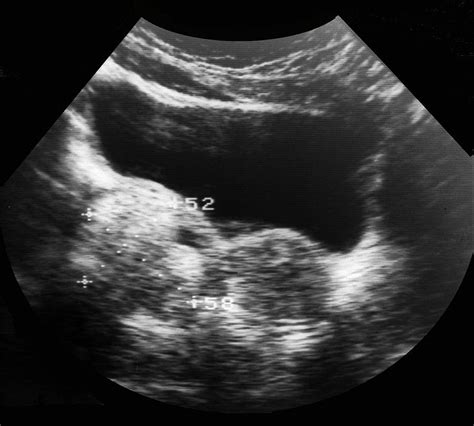 Dermoid Ovarian Cyst Photograph By Zephyrscience Photo Library Pixels