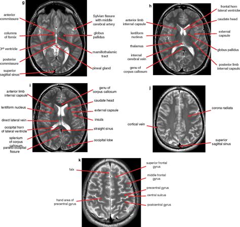 Normal Anatomy Of The Brain On Ct And Mri With A Few Normal Variants Practical Neurology