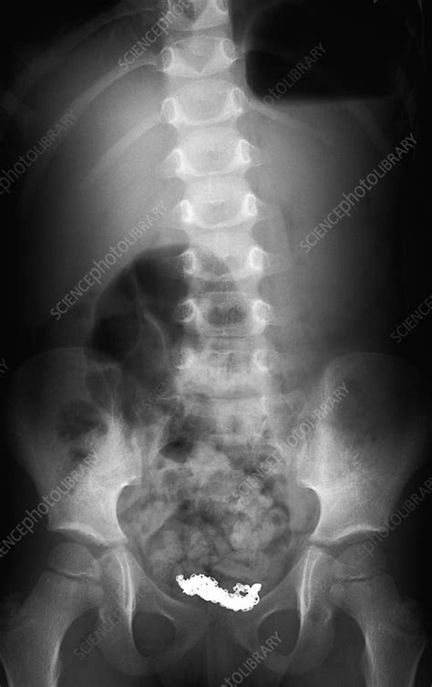 Swallowed Necklace X Ray Stock Image C0269973 Science Photo Library