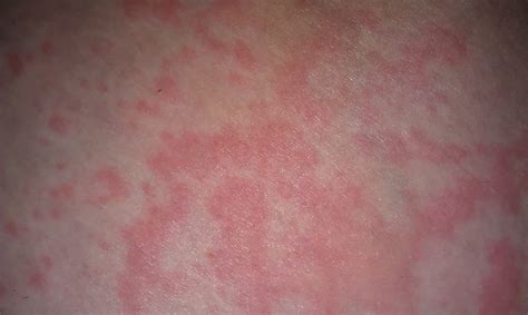 Skin Rash Under Arms Pictures Photos