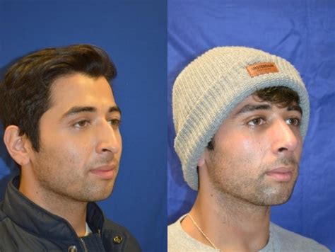 Nose Surgery Before And After Photos Patient 294 San Francisco Ca