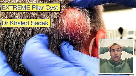 Exploding Cyst Pilar Dr Khaled Sadek Youtube
