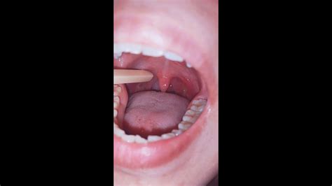 Another Video Of Tonsil Stones Youtube