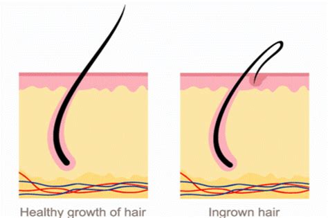 What Causes Ingrown Leg Hairs And How To Prevent Them