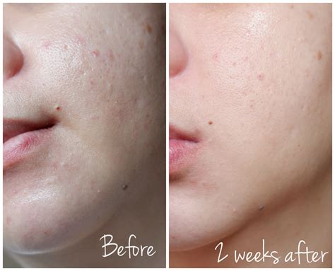 How to Treat Fungal Acne, and How to Know if You Have it | Fashion 360