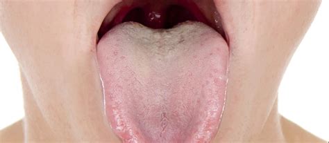 Sore Throat And Tongue