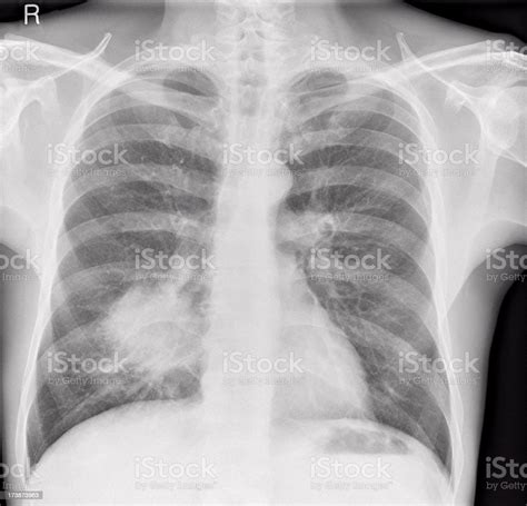 Chest Xray Of Lung Cancer In A Man Stock Photo Download Image Now