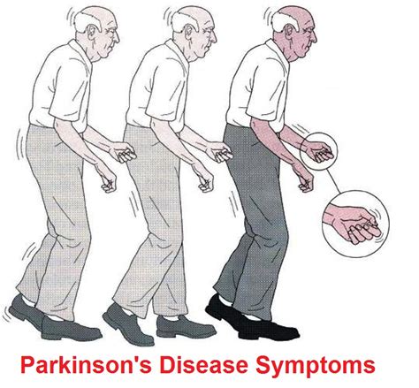 Parkinsons Disease Signs And Symptoms Diagnosis Treatment And
