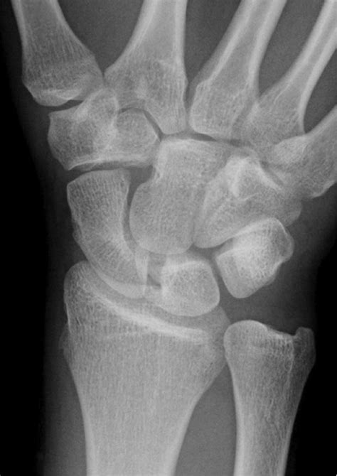 Lateral Wrist X Ray Labeled