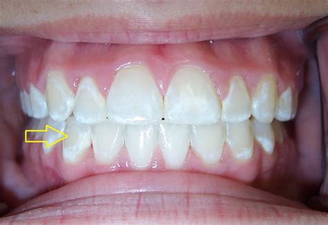 White Spots On Your Teeth Heres What You Need To Know