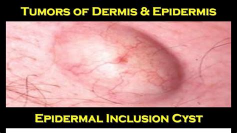8d Epidermal Inclusion Cyst Youtube