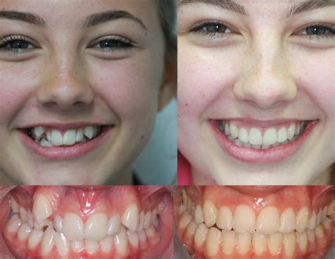 Before After Magic Transformational Power Of Braces On Teeth