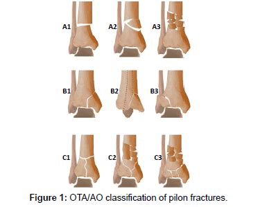 Minimally Invasive Treatment Protocol for Closed Pilon ...