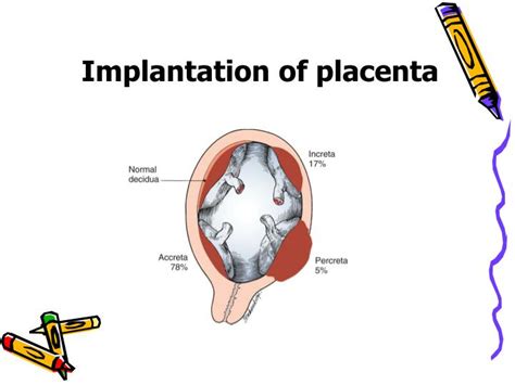 Ppt Placenta Previa Placental Abruption Powerpoint Presentation Id