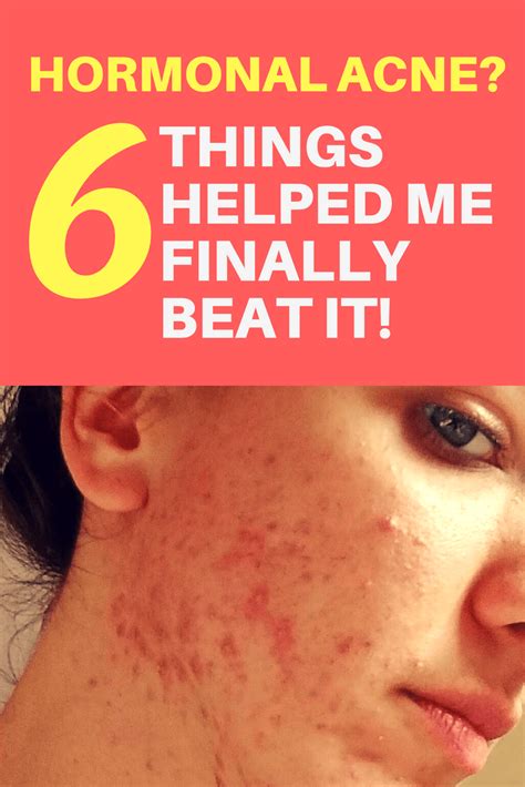 i beat hormonal acne my 6 powerful little secrets acné traitement naturel acné hormonal
