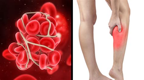 Signs And Symptoms You Have A Blood Clot And Might Not Even Know It