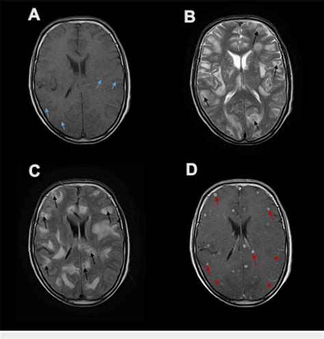 Axial MR Imaging Of Brain At The Level Of Basal Ganglia Multiple Small Download Scientific