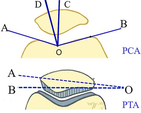 Patellar Congruence Angle Pca And Patella Tilt Angle Pta The Pca