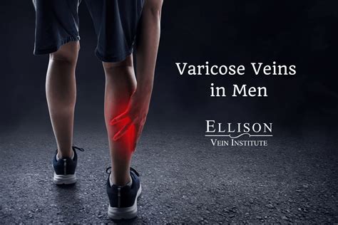 Varicose Veins And Running