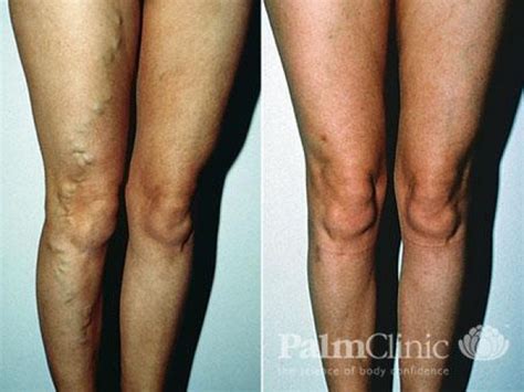 Varicose Veins Causes Symptoms Removal And Treatments Auckland Nz