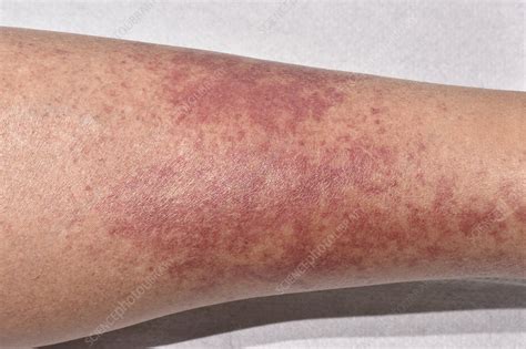 Allergic Vasculitis Stock Image C0498388 Science Photo Library