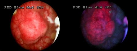 Surveillance in patients with in situ carcinoma. Non-muscle invasive bladder tumor on the posterior wall ...