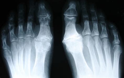Arthritis Of The Big Toe Treatment Melbourne Mr Keith Foot Surgeon