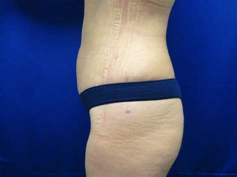 hopkinsville ky tummy tuck lipoabdominoplasty before and after photos paducah ky plastic