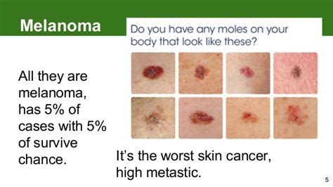 The medical, social and economic benefit of diagnostic tests are often overlooked, despite that these tests improve patient care and help to limit healthcare. Melanoma: how to detect skin cancer