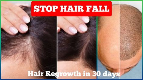 Stop Hair Fall Regrow Lost Hair Naturally Hair Fall Solution At Home
