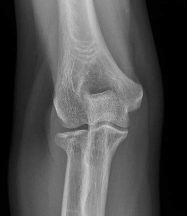 Elbow Joint Effusion Fat Pad Sign Radiology Case Radiopaedia Org