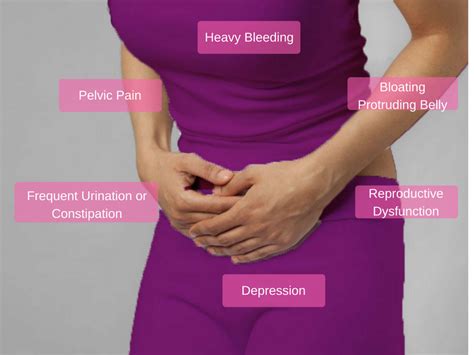 All You Need To Know About Fibroids Symptoms Treatment And Diagnosis