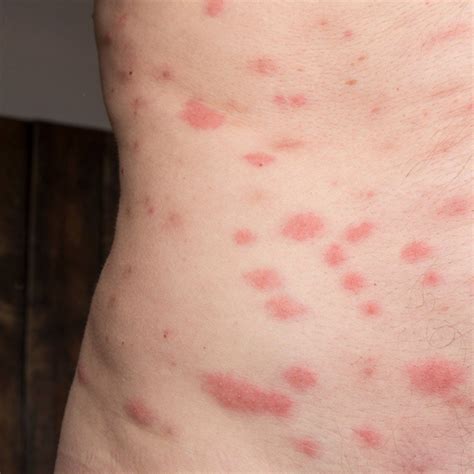Bed Bug Bite Marks Cure For Bed Bugs Kill Bed Bugs Rid Of Bed Bugs Bed Bugs Signs Bed Bug