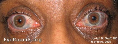 Atlas Entry Scleritis Scleral Thinning