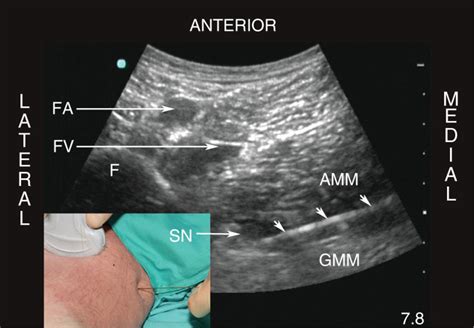 Ultrasound Guided Anterior Sciatic Nerve Block In The Proximal Thigh