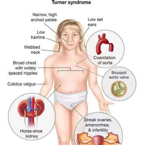 Clinical Signs Of Turner Syndrome Medizzy