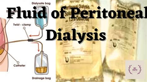 Fluid Of Peritoneal Dialysisperitoneal Dialysis Fluiddialysate Of