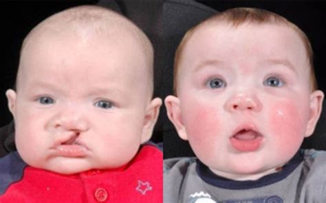 Cleft Lip And Palate Before And After