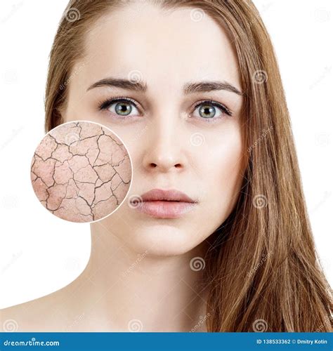 Zoom Circle Shows Dry Facial Skin Before Moistening Stock Photo