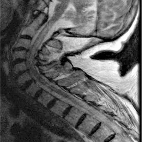 Sagittal Spinal Cervical Mri Of Case 2 T2 Weighted Image Showing A