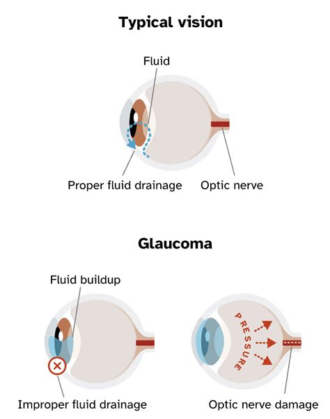 Glaucoma Genetics And More 23andme